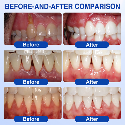 🇬🇧Pureluxo® 🦷  periodontal repair gel 🧑‍⚕️