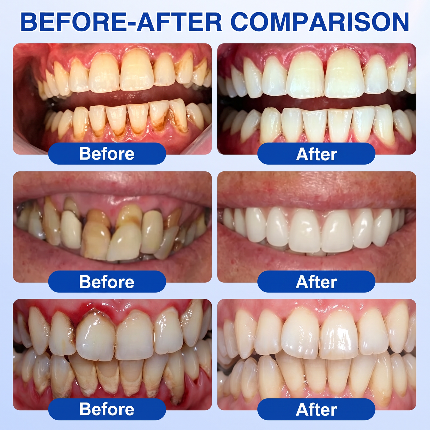 🇬🇧Pureluxo® 🦷  periodontal repair gel 🧑‍⚕️