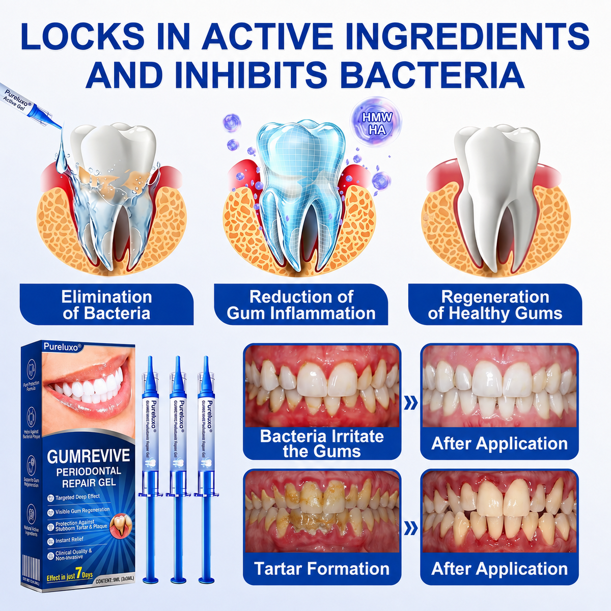 🇬🇧Pureluxo® 🦷  periodontal repair gel 🧑‍⚕️
